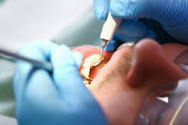 Best Emergency Dentist for Knocked-Out Tooth in Bolivar, MO